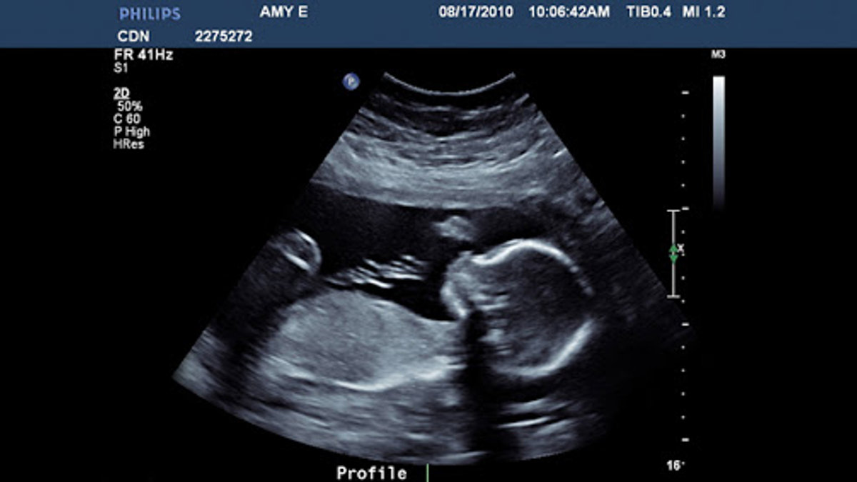 Mobile ultrasound aims to reach abortion-vulnerable women – ar