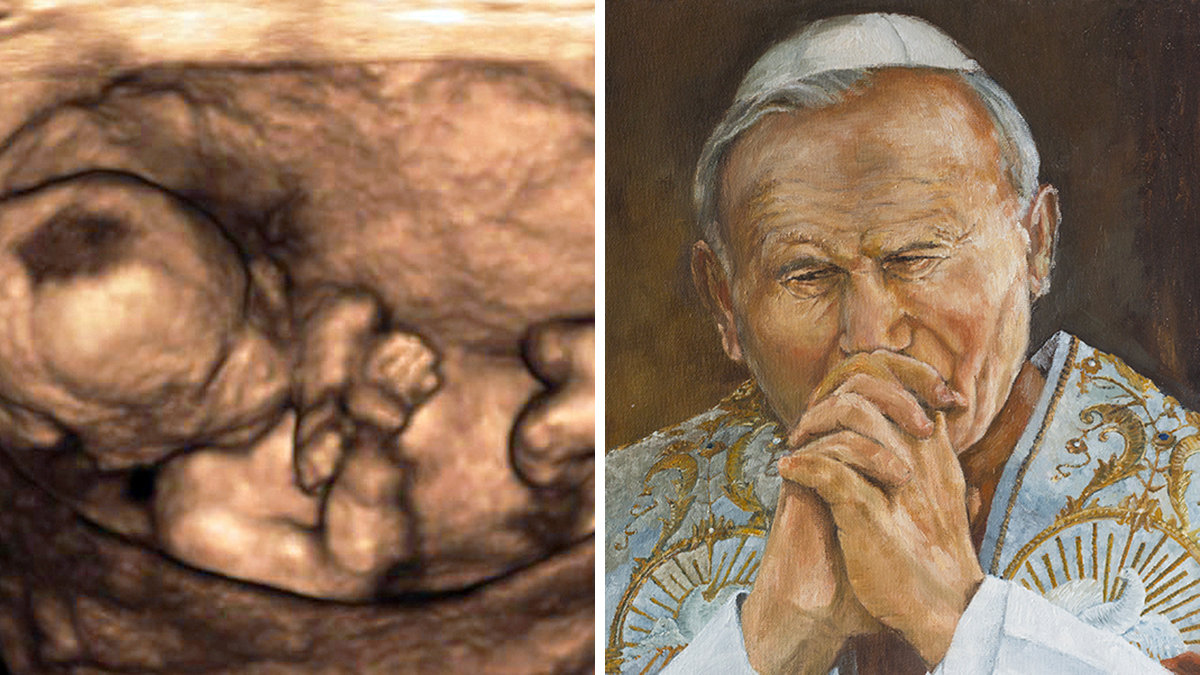 ULTRASOUND