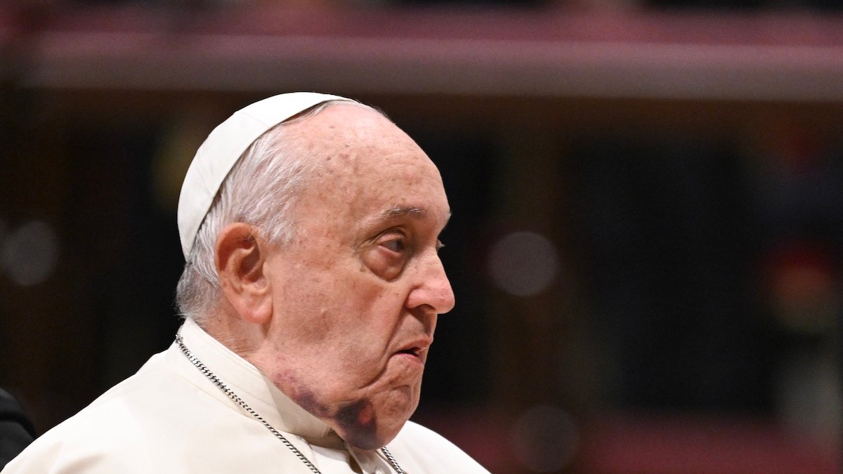 pope-bruised-chin.jpg