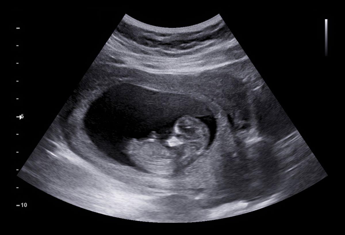 baby in the womb