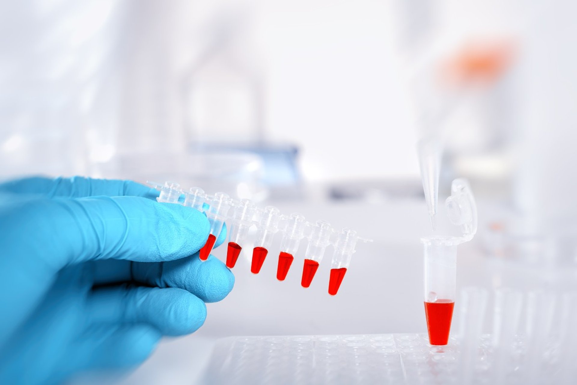 BIOMARQUEURS TRISOMIE 21