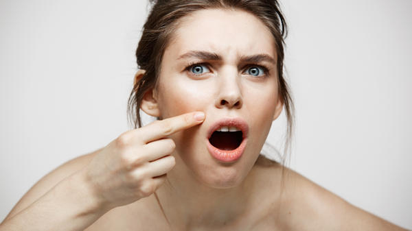 GIRL FACE ACNE