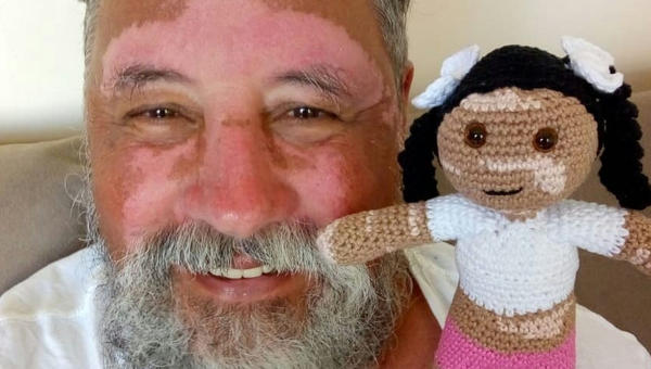 VITILIGO DOLLS