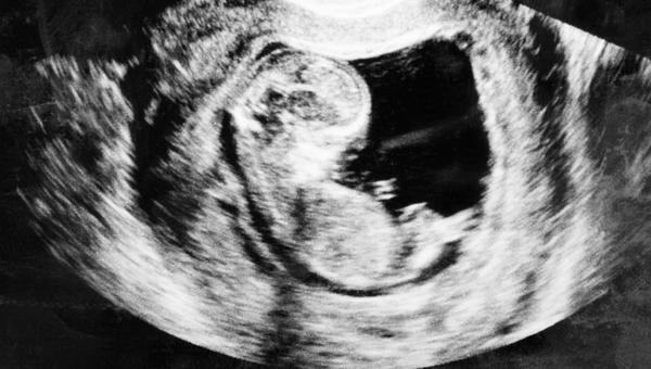 FETUS 3 MONTH,