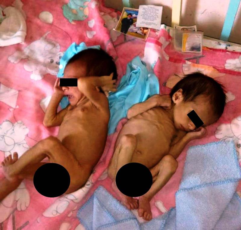 Niños Desnutridos en Venezuela – 15Enero2018 – Versión Censurada de acuerdo con la LOPNNA @GuardianCatolic